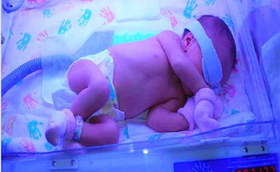 دلایل بیقراری نوزاد زیر دستگاه فتوتراپی